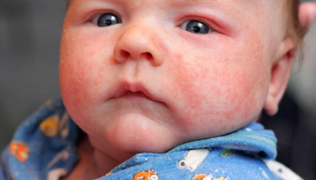 Алергічний діатез у немовлят