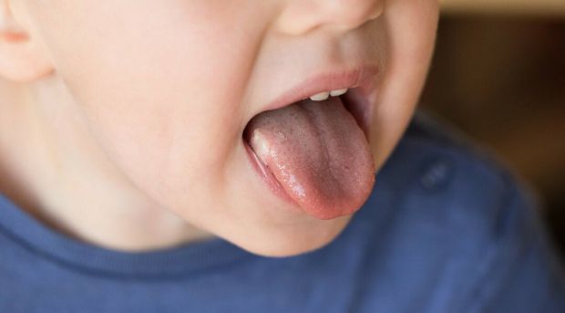 Якщо дитина вередує, відмовляється від їжі і каже, що їй боляче жувати, батьки можуть запідозрити стоматит, особливо якщо помітили на губах дитини гер