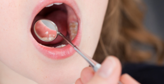 Cтоматит – одне з найпоширеніших інфекційних захворювань порожнини рота. На жаль, з такою проблемою доводиться стикатися практично кожному з батьків. 