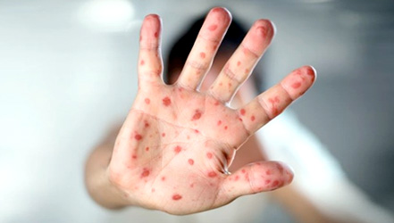 У дитини з червоними долонями і стопами, ймовірно, є вірус, який називається хворобою рук, ящур. Нерідко половина класу дитячого садка хворіє на цю хв