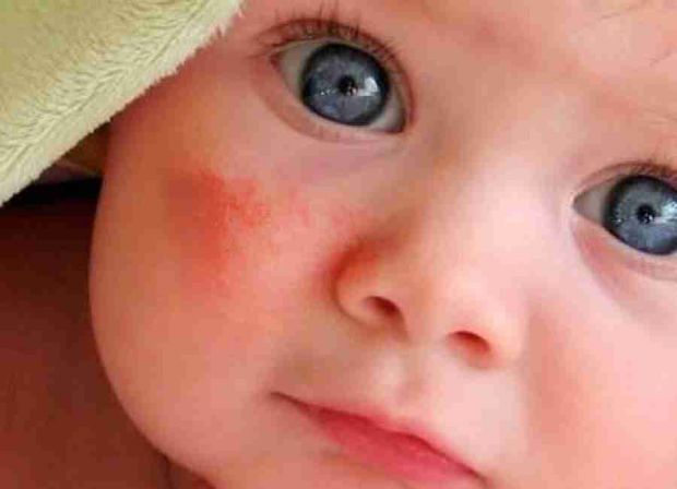 Червоні щічки, висипання, свербіж - такі симптоми у немовлят відразу викликають паніку у молодих мам. Все тому, що алергія у дітей проявляється набага