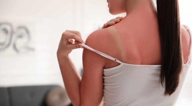 Шкіра може обгоріти лише через 15 хвилин перебування на сонці. Сонячні опіки не тільки болючі, але й можуть спричинити тонкі зморшки та рак шкіри. Щоб