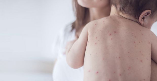 В Україні зротає кількість випадків захворювання на кір серед дітей За перші місяці 2025 року зафіксували 1 196 випадків. Це у понад 11 разів більше, ніж за аналогічний період минулого року. Про це повідомив заступник