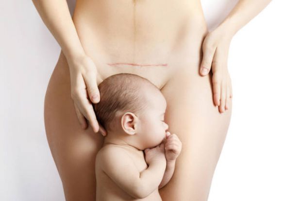 Як доглядати за швом після кесаревого розтину? Одразу після пологів шов може сильно боліти. Це пов’язано з тим, що фізичного втручання зазнають одразу три види тканини: м’язові, жирові, шкіряні. От